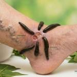Leech Therapy for Chronic Varicose Ulcers